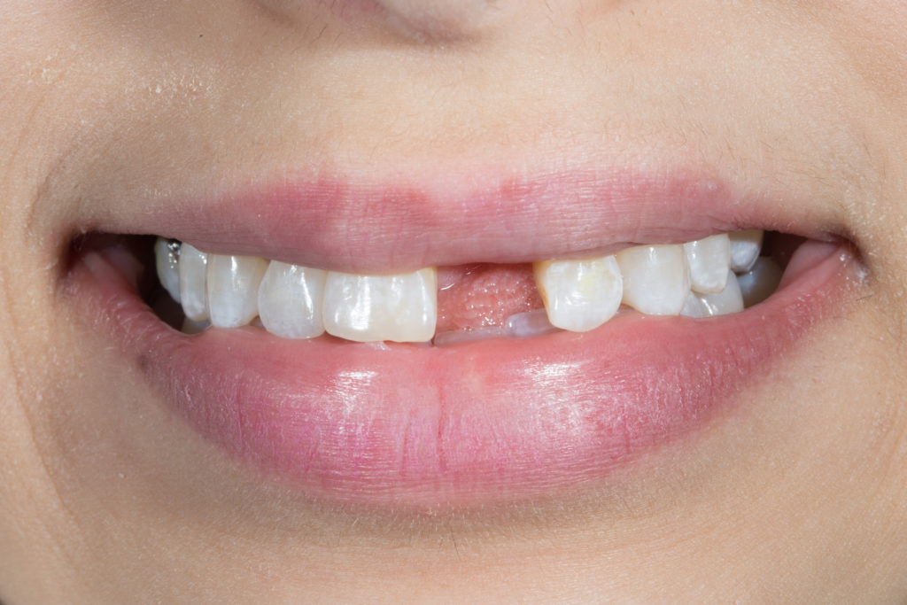 Remplacement d’une incisive par un bridge — vue clinique 1