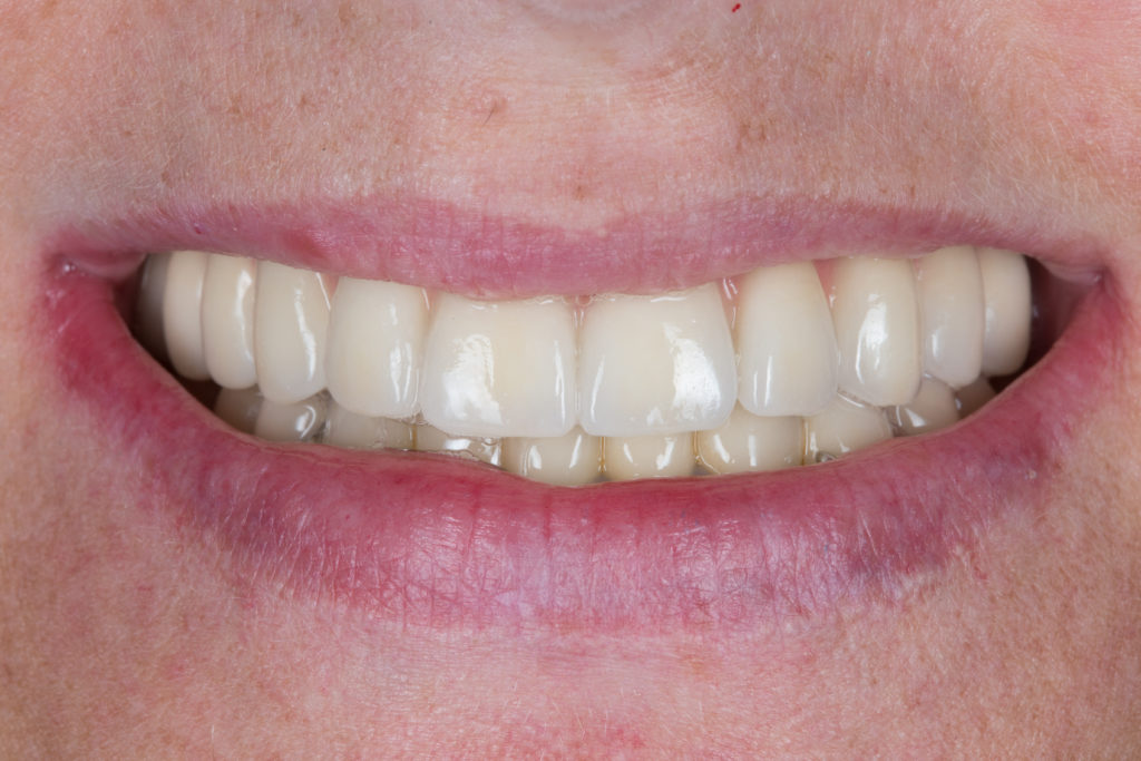 Bridge en céramique sur implants — vue clinique 2