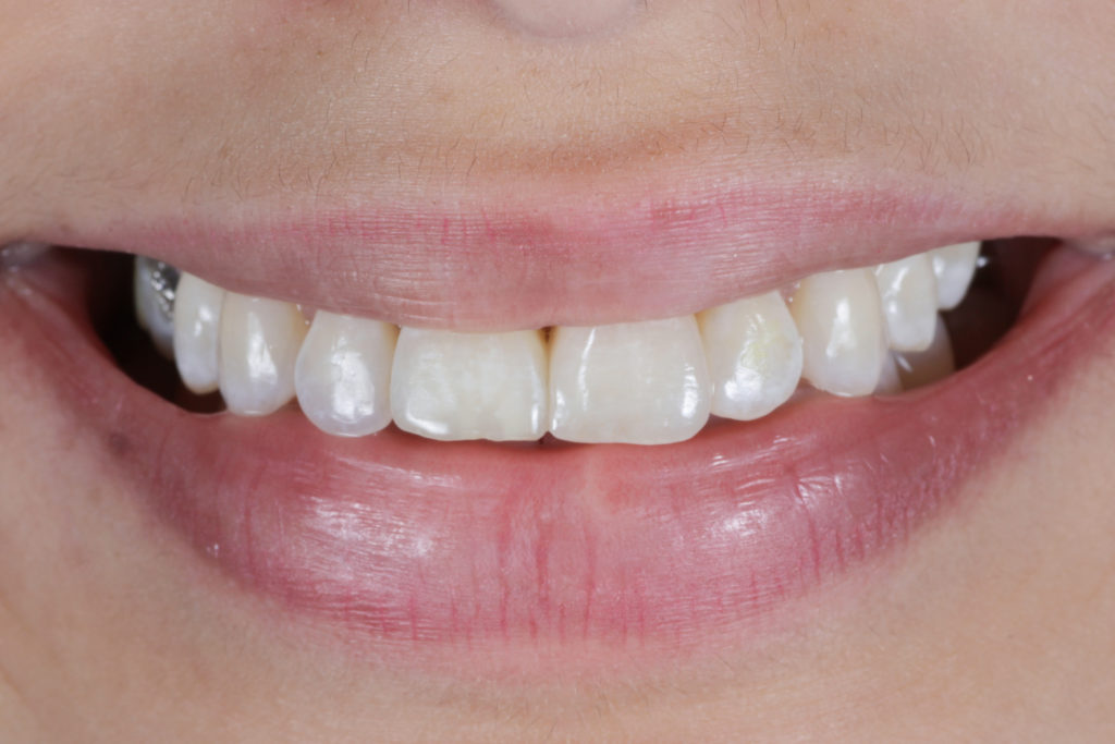 Remplacement d’une incisive par un bridge — vue clinique 2