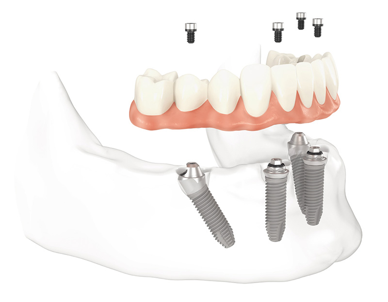 Schéma d’une prothèse complète mandibulaire fixée sur quatre implants